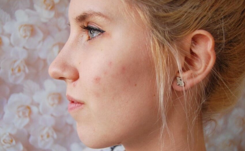  Acne Scars: Best Home Remedies for Acne Scars