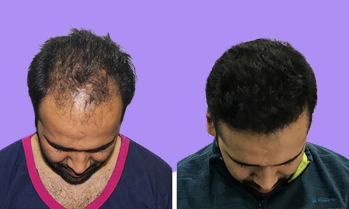  Finding the Best Hair Transplant Clinic