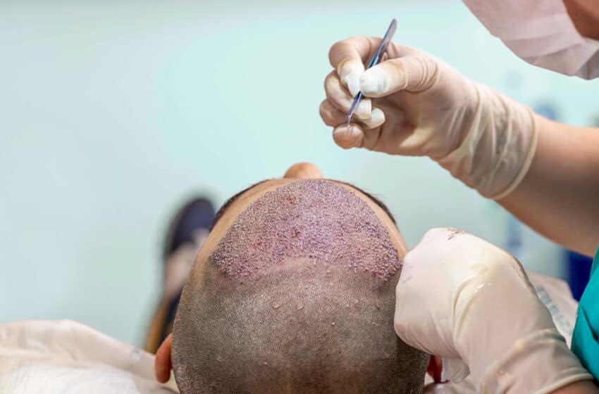  Best Hair Restoration Surgery Clinic in Lahore Pakistan