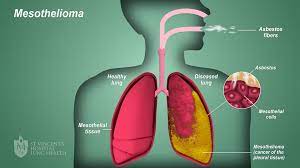  Understanding Mesothelioma: Causes, Symptoms, and Treatment Options